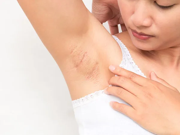 Nách thâm khiến nhiều người mất tự tin khi mặc đồ