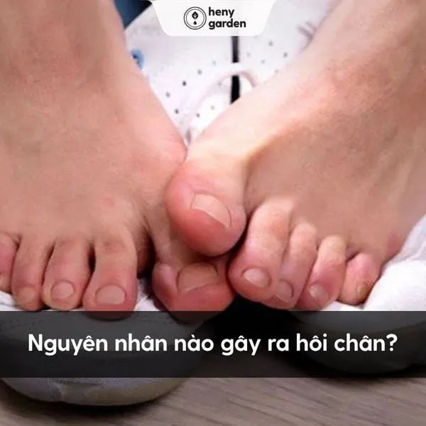 Bàn chân đổ mồ hôi tạo môi trường cho vi khuẩn gây hôi chân