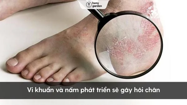 Vi khuẩn và nấm hoạt động mạnh khi chân có mồ hôi gây mùi hôi chân