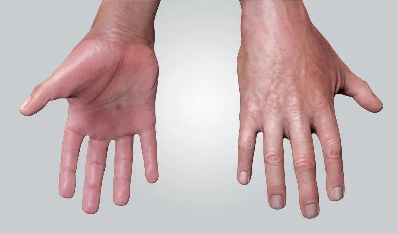 Cách Điều Trị Ra Mồ Hôi Tay Chân Hiệu Quả Và Toàn Diện