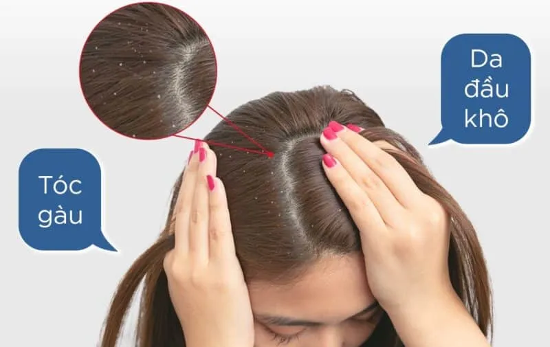 Da đầu khô tróc vảy và hiện tượng gàu gây ngứa da đầu và mặt