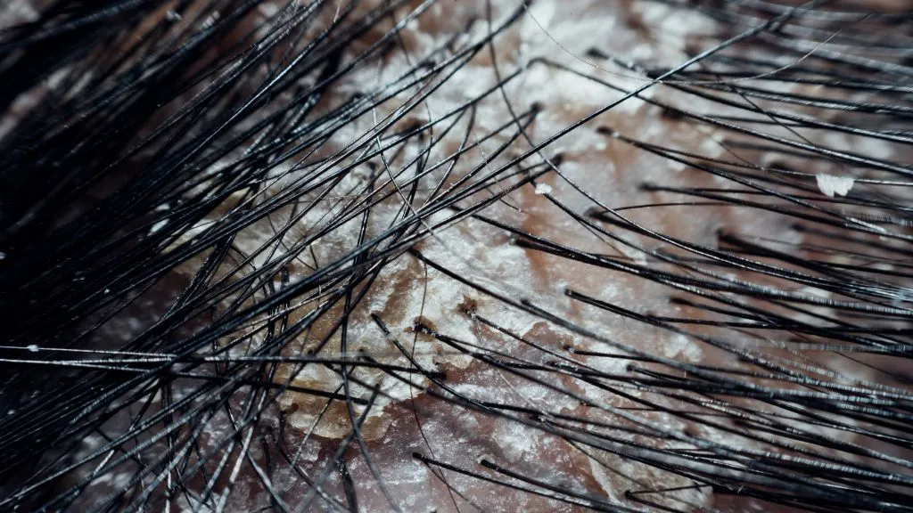 Các loại nấm da đầu thường gặp và cách nhận biết sớm 1