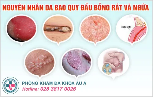 Da bao quy đầu bỏng rát và ngứa là dấu hiệu nhiều bệnh nguy hiểm