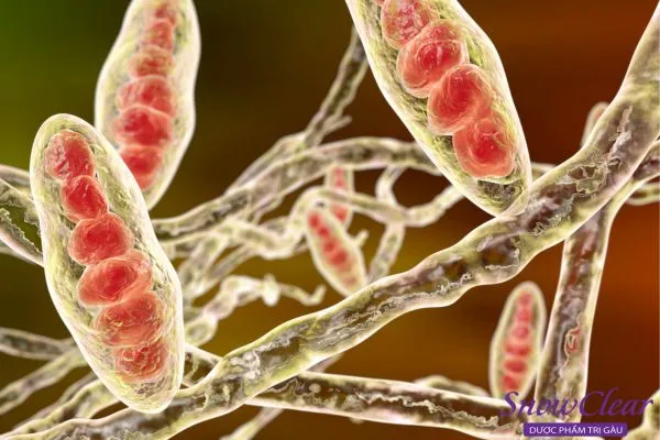 Mô tả tổn thương dạng mảng hói và tóc cụt do chủng nấm Trichophyton gây ra.