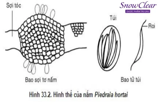 Hình ảnh bệnh tóc hột (Piedra) với các hạt nấm bám dọc theo thân tóc.