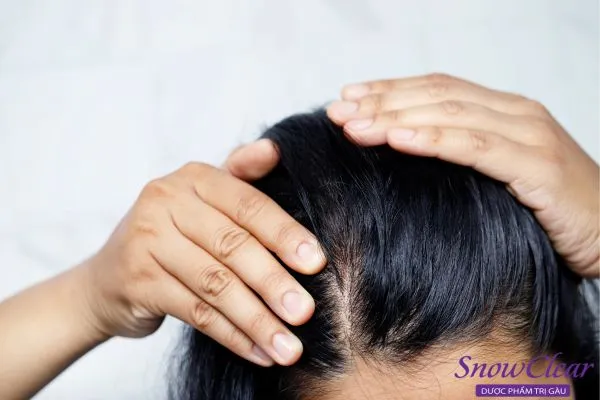 Vệ sinh kém là một trong những nguyên nhân chính bị nấm da đầu là gì.