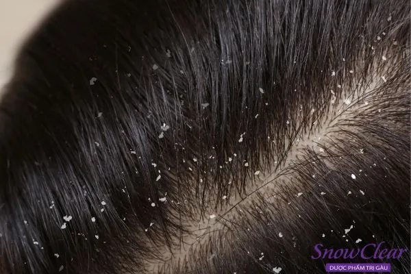 Tình trạng bong tróc vảy gàu trắng do da đầu bị nấm và tăng tiết bã nhờn.