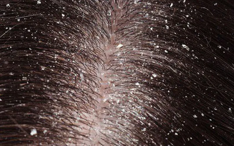 Thuốc Trị Gàu Da Đầu Chuyên Sâu, Giải Pháp Dứt Điểm Tình Trạng Bệnh