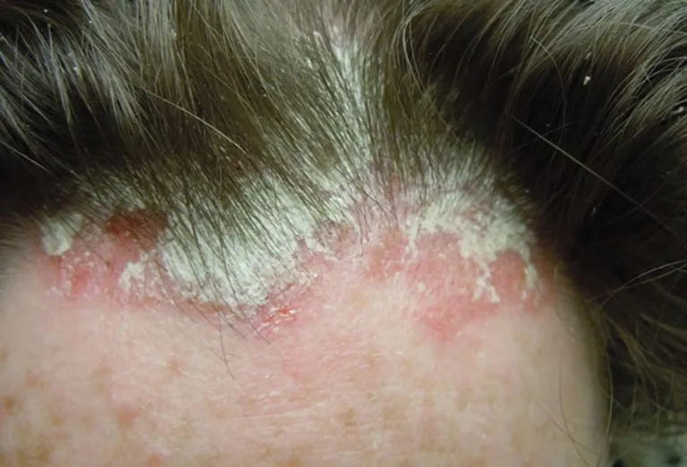 Vi khuẩn nấm da đầu Tinea capitis gây tổn thương và có nguy cơ lây lan xuống da mặt