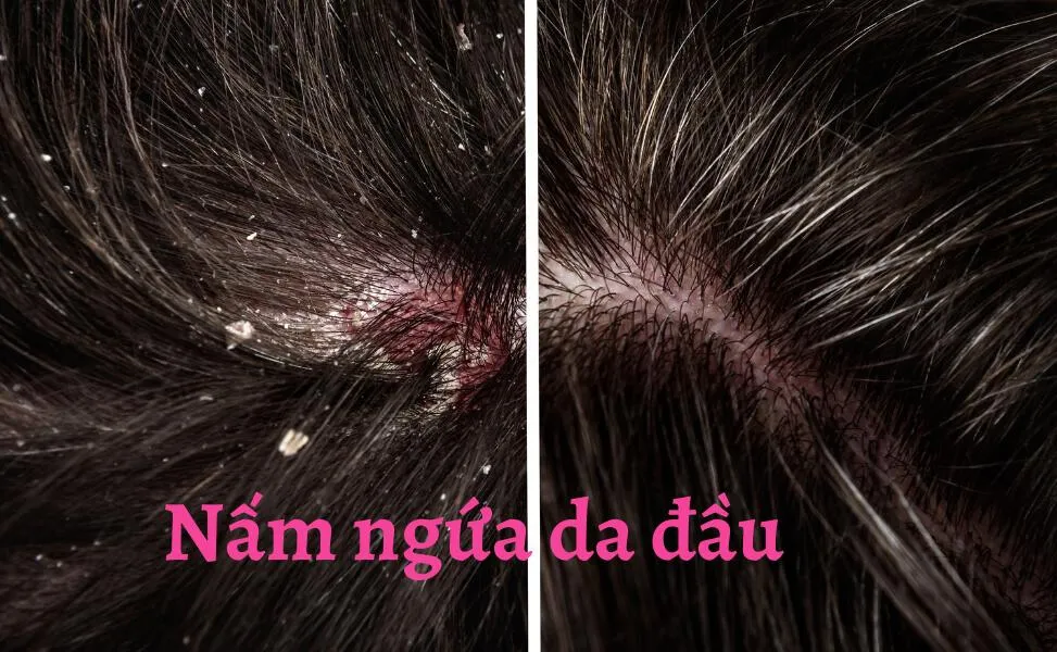 Hình ảnh minh họa da đầu bị ngứa và chảy nước do nấm tấn công.