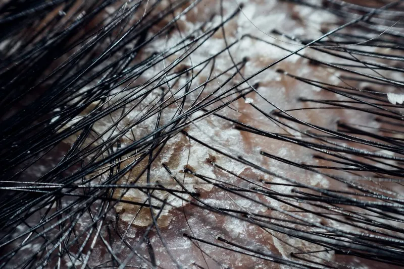 Nấm da đầu có nhiều nguyên nhân khác nhau