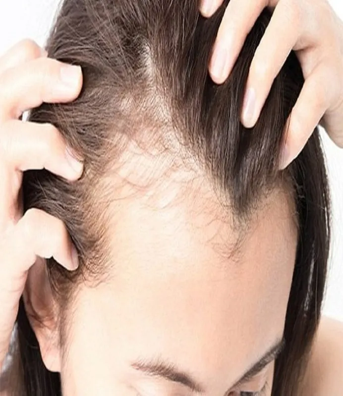 Các nguyên nhân chính gây ra viêm da đầu do tăng tiết bã nhờn và nấm